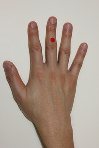 高麗手指鍼での頸椎椎間板ヘルニアのツボの位置